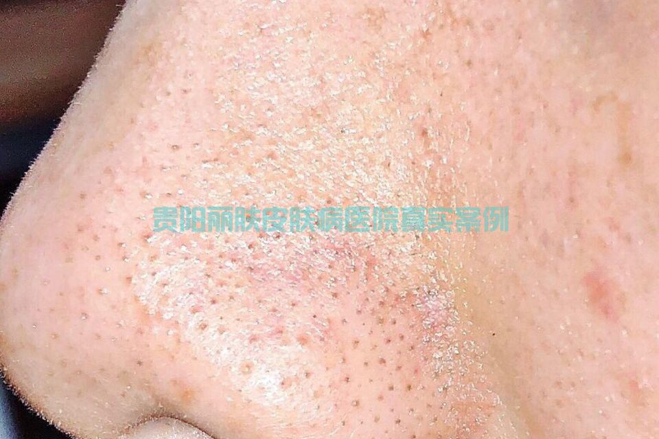 黑头粉刺