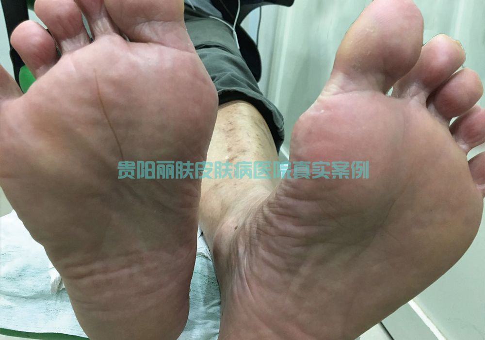 脚癣